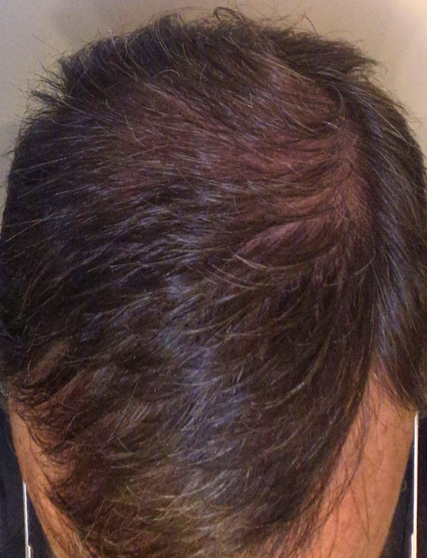 Armin H. nach etwas über sechs Monaten mit ribogrow®: dichteres Haar am Oberkopf