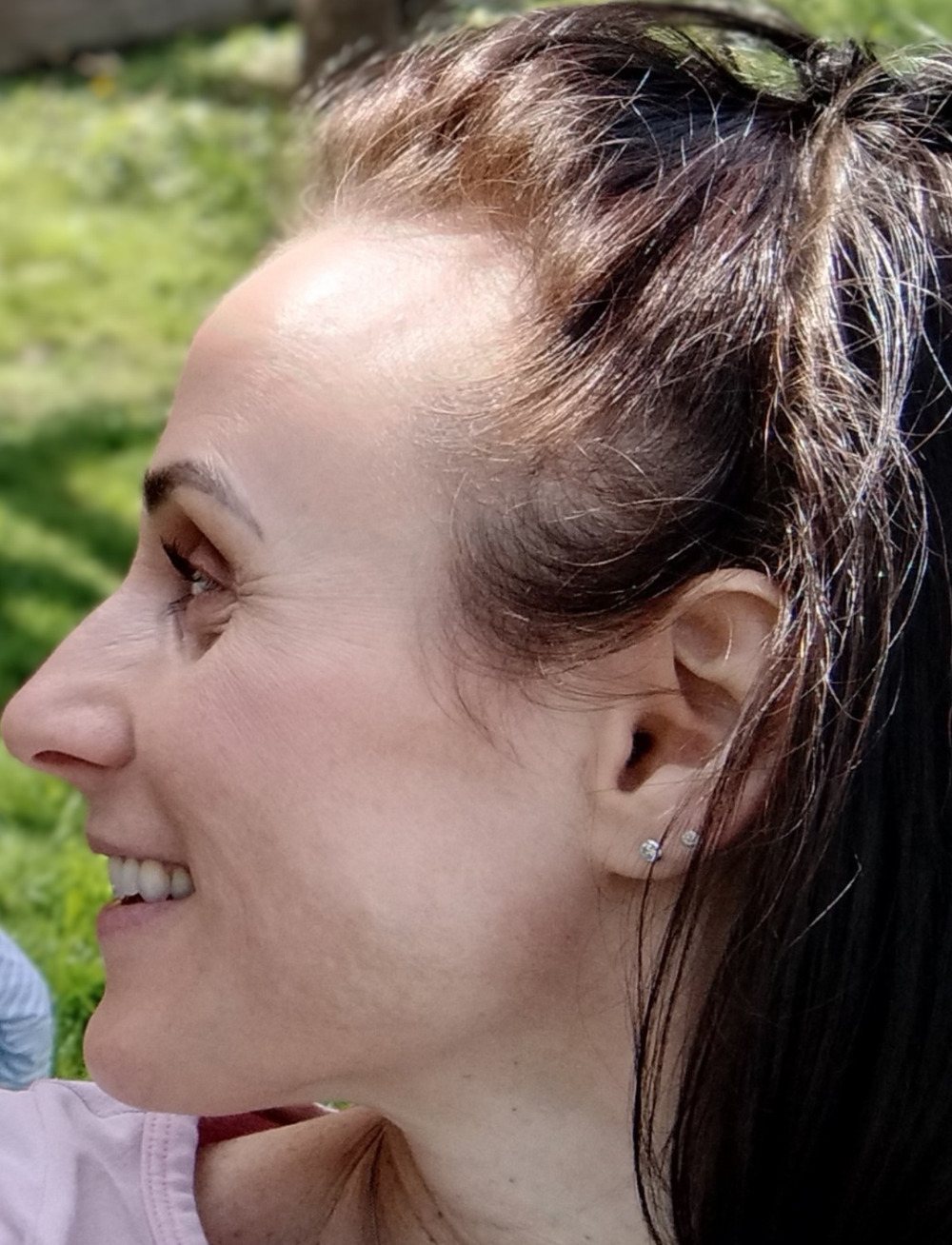 Carina H. vorher: ausgedünntes Haar an den Schläfen und am vorderen Haaransatz