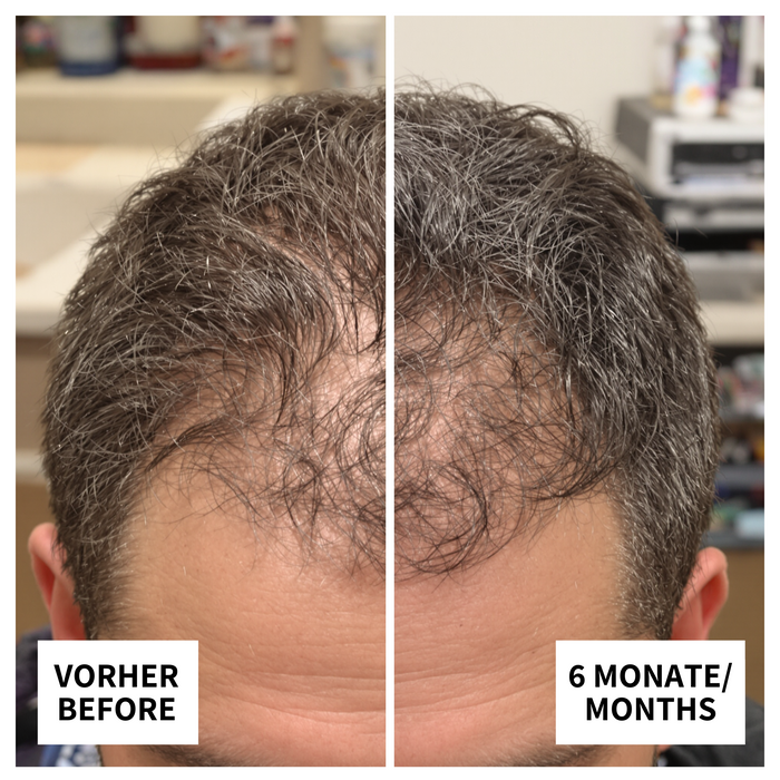 Vorher-Nachher-Bild: Yasin aus Essen nach 6 Monaten Anwendung von ribogrow – deutlich volleres, gesünderes Haar mit sichtbarem Haarwachstum.