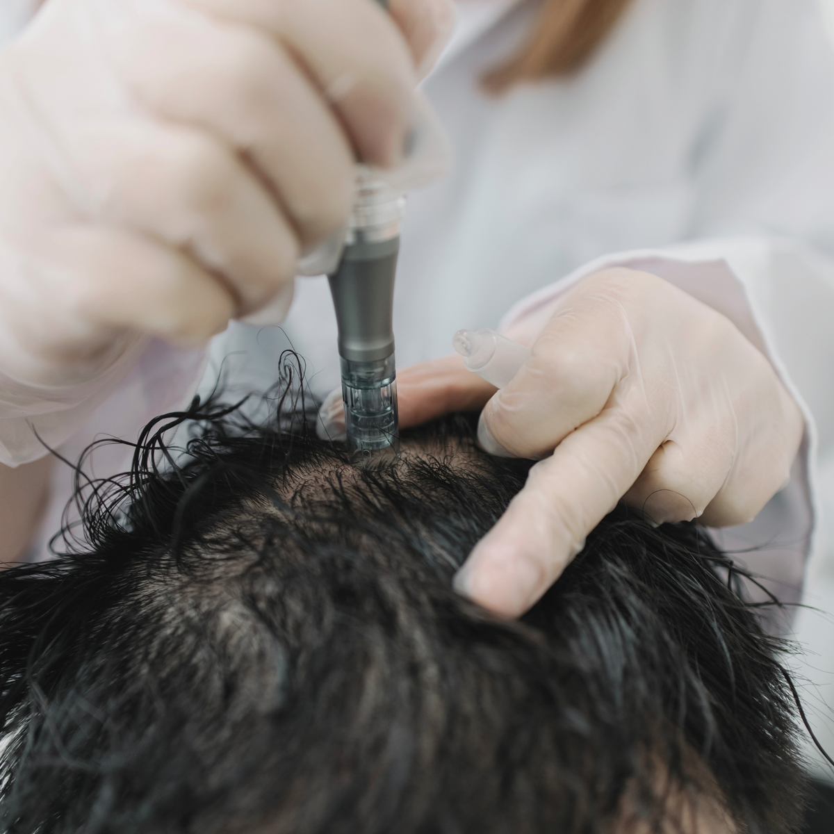 Microneedling gegen Haarausfall: Ein umfassender Leitfaden zu Wirksamkeit und Mechanismen