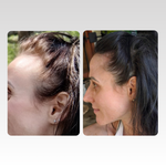 Zeigt das vorher nachher Bild einer Nutzerin des ribogrow® Hair Booster Serum. Links hat sie große Geheimratsecken und einen zurückweichenden Haaransatz, rechts ist das Haar voller.