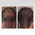 Zeigt das vorher Nachher Bild eines Nutzers des ribogrow® Hair Booster Tonic. Dirk H. Links hat er bedeutend weniger Haare, rechts ist das Haar viel dichter. 