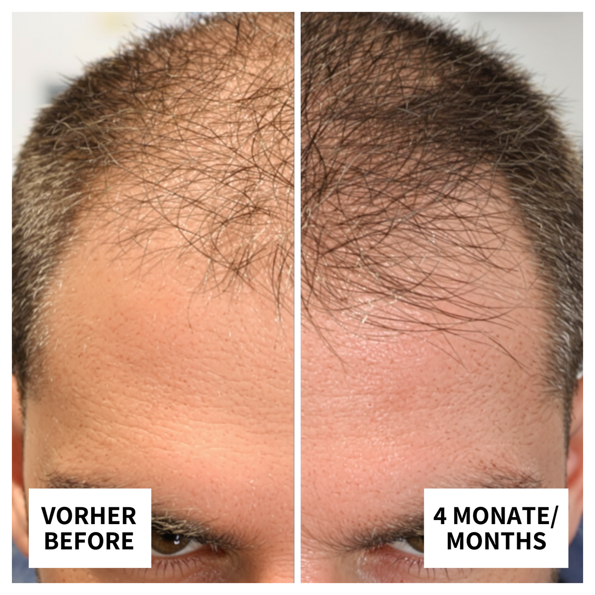 Vorher-Nachher-Bild: Matthias aus Hamburg nach 4 Monaten Anwendung von ribogrow – sichtbar dichteres, gesünderes Haar und verbesserter Haarwuchs.