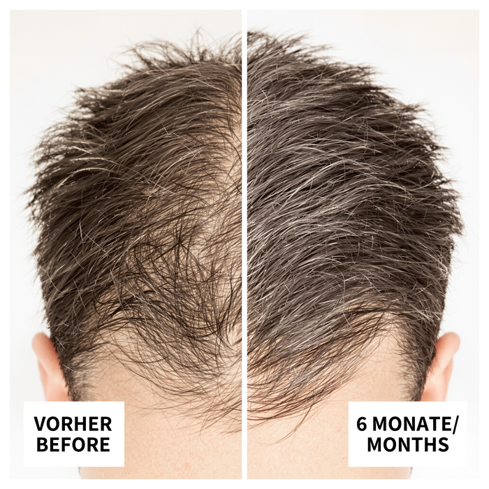 Vorher-Nachher-Bild: Marcel aus Berlin nach 6 Monaten Anwendung von ribogrow – deutlich dichteres und gesünderes Haar mit verbessertem Haarwachstum.