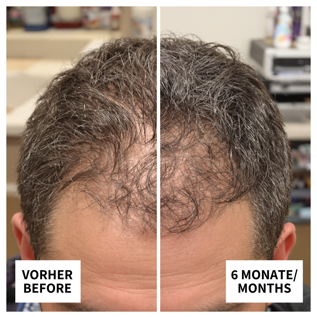Vorher-Nachher-Bild: Yasin aus Essen nach 6 Monaten Anwendung von ribogrow – deutlich volleres, gesünderes Haar mit sichtbarem Haarwachstum.